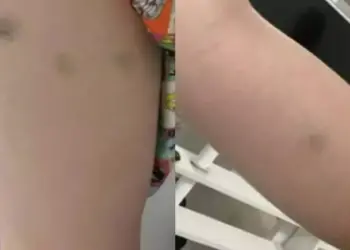 Caso Naiara Azevedo: fotos mostram hematomas causados pelo ex