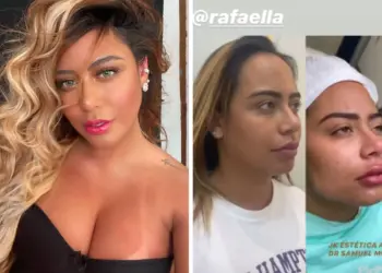 Antes e depois de Rafaella Santos: irreconhecível após plásticas, irmã de Neymar coleciona procedimentos. Veja o que ela já fez!